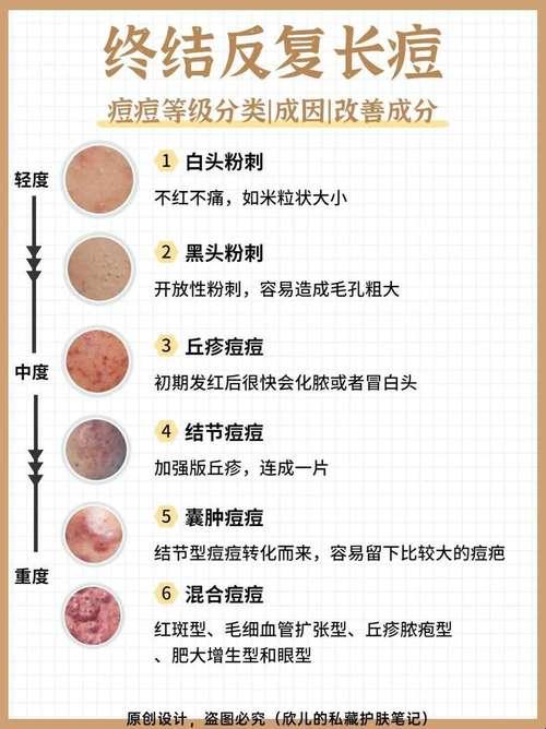 战痘界的武林秘籍：笑傲痘峰，一招制胜！